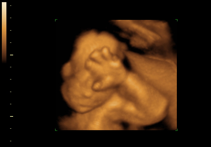 3D ultrasound image at 23 weeks